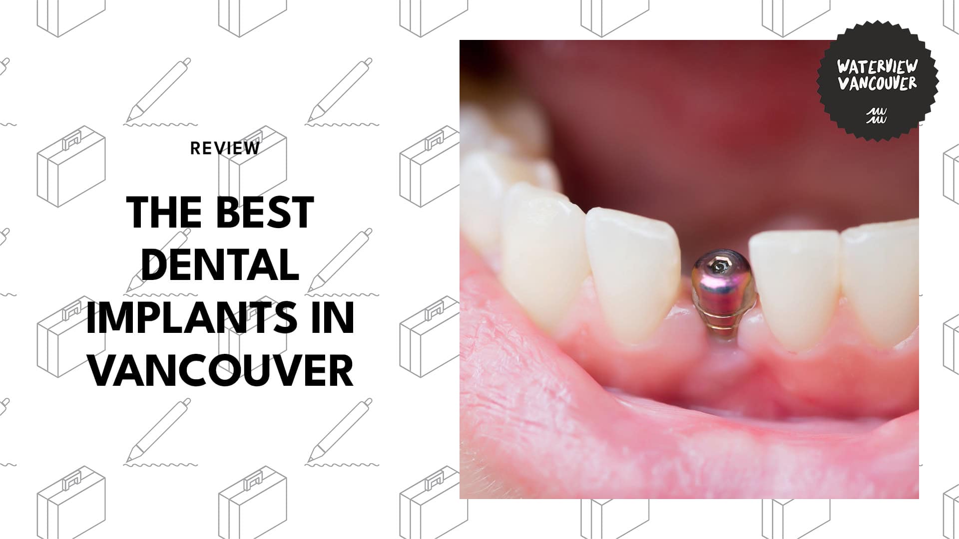 dental-implants-in-vancouver