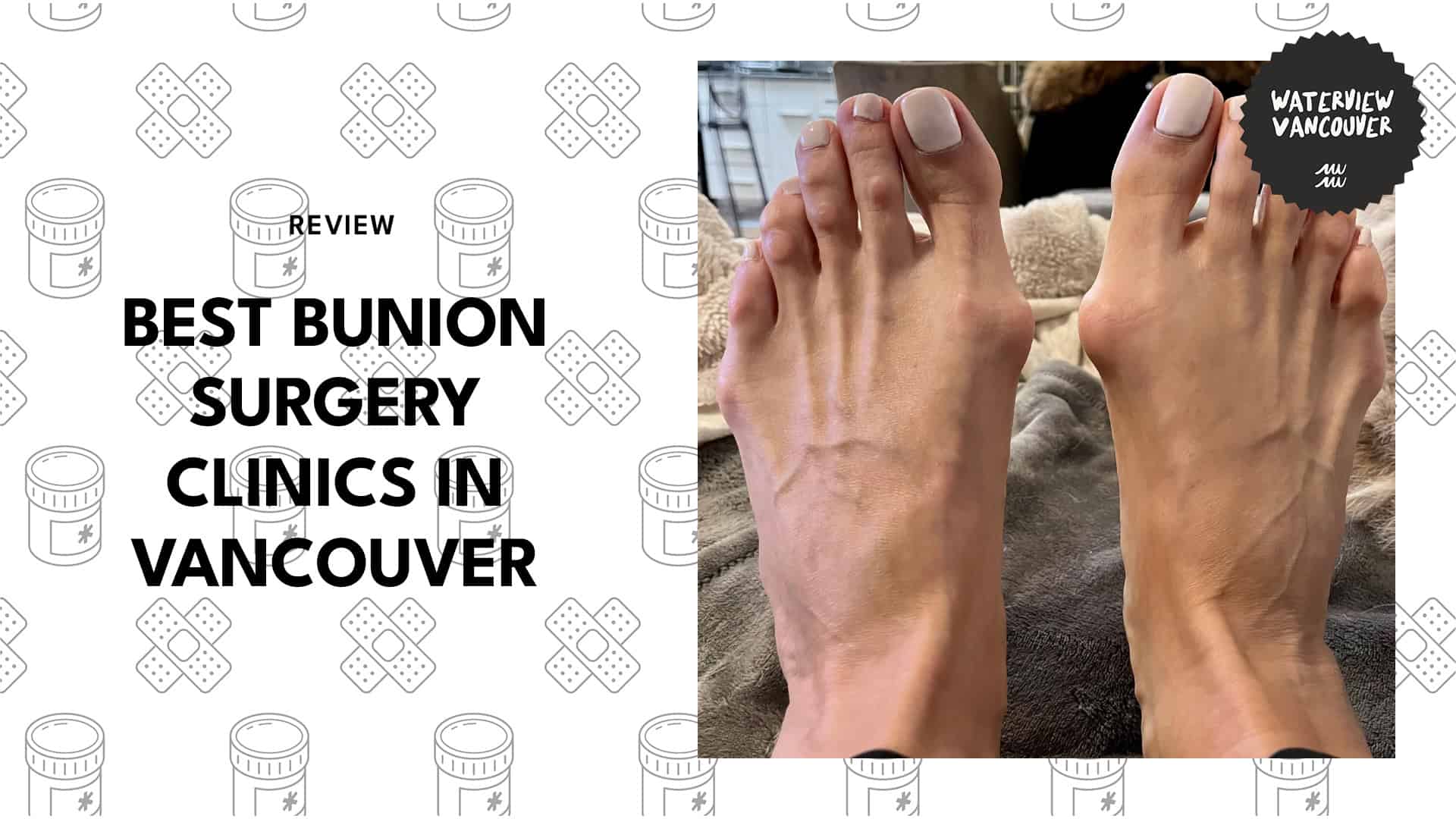 bunion-surgeries-in-vancouver
